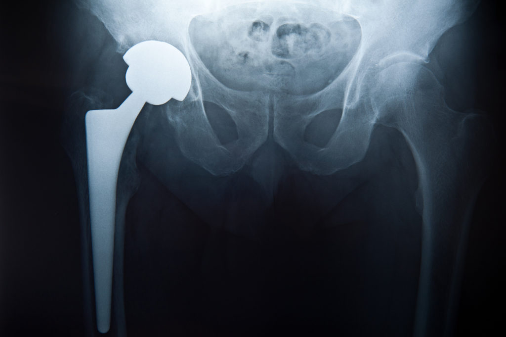 x-ray of patient’s hips with ball joint replacement in right hip