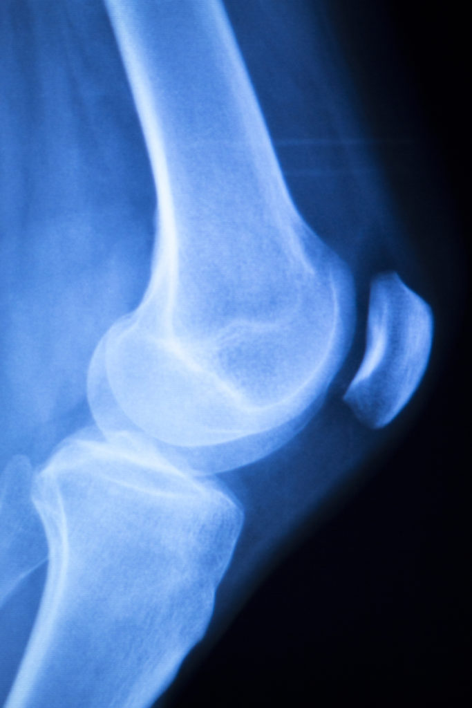 meniscus shown in an xray