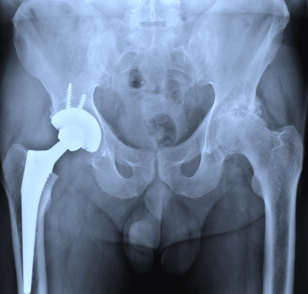 X-ray of the hip prostesis
