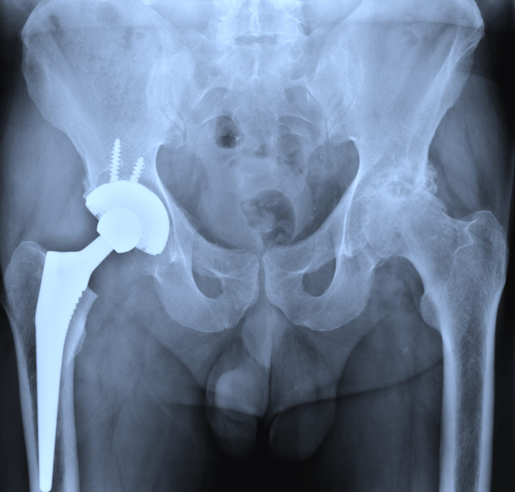 X-ray of a hip replacement after hip fracture