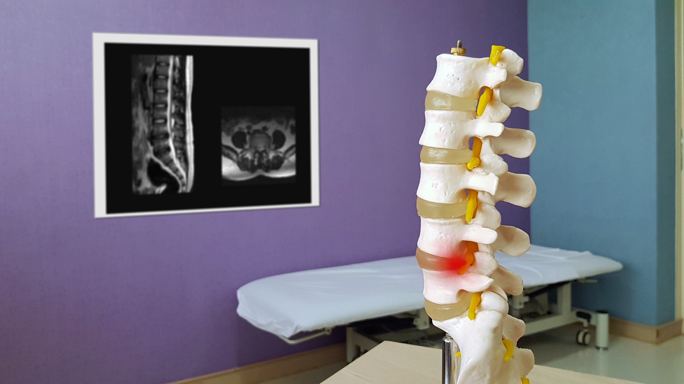 model spine in doctor's office with red glowing dot on second to lowest disc, resembling pain of lumbar spinal stenosis, with light blue gurney and spinal x-rays on purple wall in the background